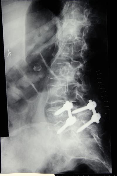 One can look at the health of the discs, facets, nerve root foramen, alignment, look for pars defects (spondylolisthesis) and scoliosis. What is a Lumbar Spine Xray? | Two Views