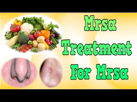 Consult a doctor for medical advice. Mrsa, Mrsa Boil, Treatment For Mrsa, Is Mrsa Curable ...