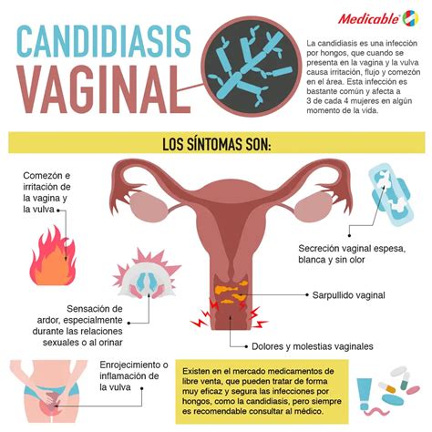 Candidiasis Vaginal Medicable