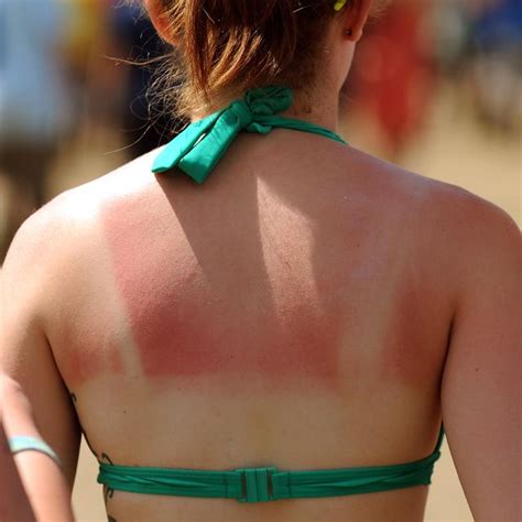 Can You Get A Third Degree Sunburn Severe Sunburn Treatments
