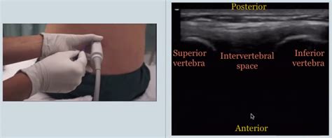 Ultrasound Guidance For Lumbar Puncture Laptrinhx News