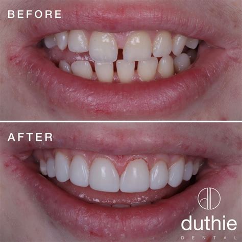 Is Composite Bonding Right For You Duthie Dental