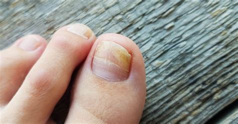 Why Are My Toenails Yellow Facty Health