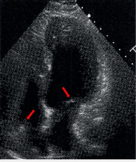 An Echocardiogram Image Of The Patient With Mildly Enlarged Left