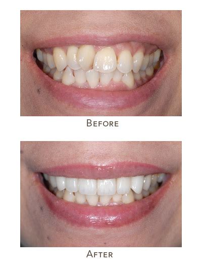 Straighten teeth without braces can be fun for everyone. How to get straight teeth quickly | Crooked front teeth ...