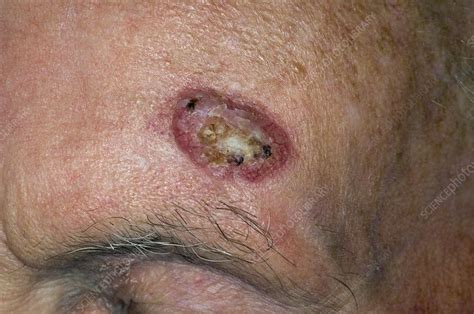 Skin Cancer On Forehead Stock Image C0083660 Science Photo Library