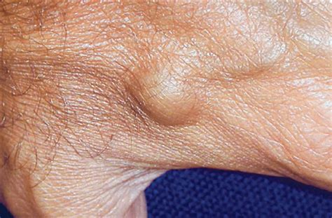 A Painful Blue Nodule On The Dorsum Of The Hand—diagnosis Pain