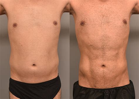 Lipo With Liposculpture In Men Case