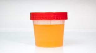 Check spelling or type a new query. Urine Berwarna, Hati-hati 5 Penyakit Ini