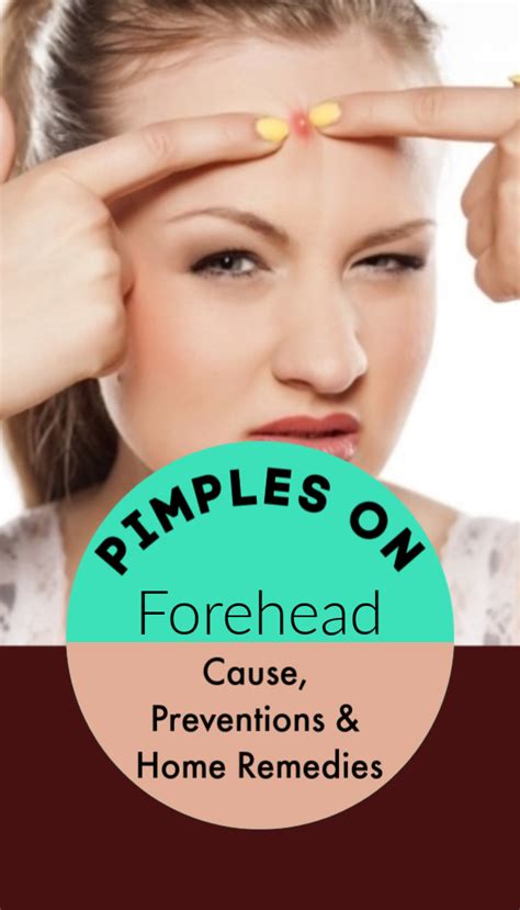 Pimples On Forehead - Causes, Prevention & Best Home ...