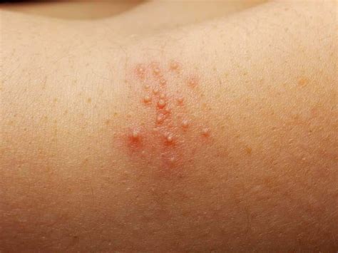 How To Treat Groin Rashes The Rash Is Known To Often Affect Areas Of