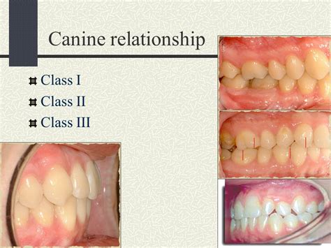 Dental Anatomy And Occlusion Dent Ppt Video Online Download