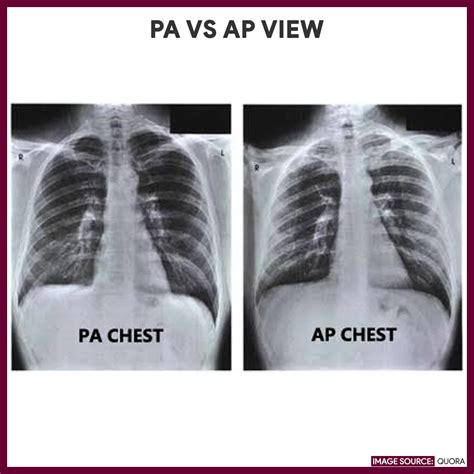 Pa And Lateral Chest X Ray
