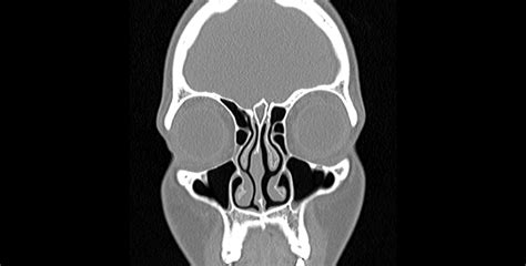 Chronic Sinusitis Imaging Dr Jeeve Ent Specialist