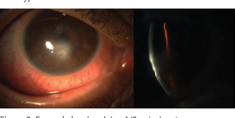 Figure 1 From Mucus Fishing Syndrome A Case With Sterile Corneal Ulcer