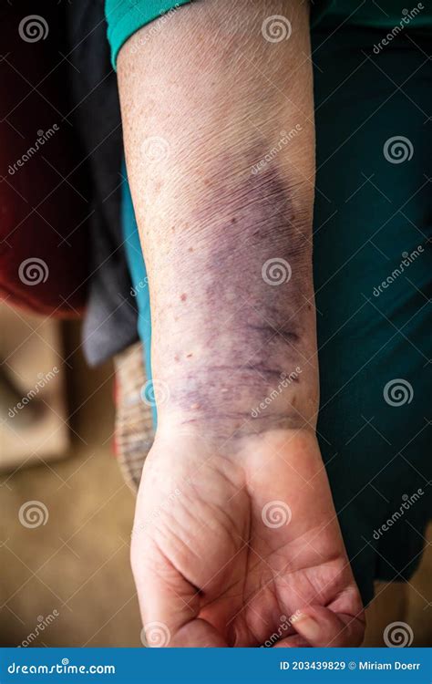 Hematoma On The Skin Of The Legs Royalty Free Stock Photography