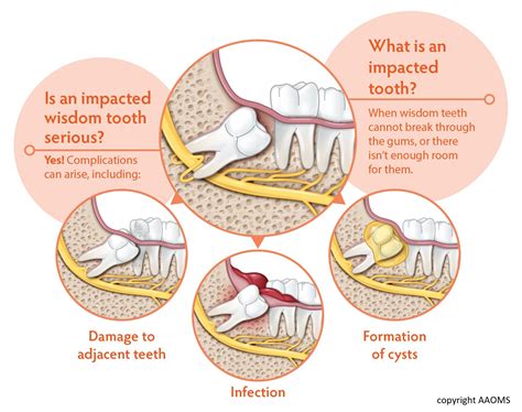 Wisdom Teeth Brea Ca Third Molars Impacted Tooth