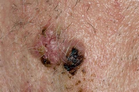 Basal Cell Carcinoma On The Face Stock Image C0029630 Science