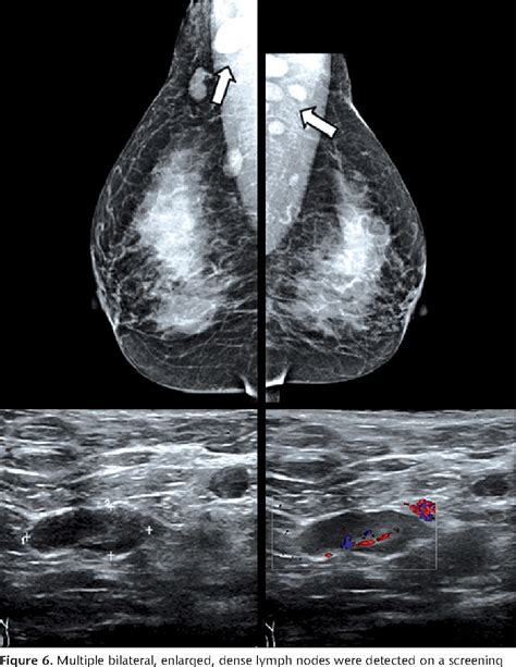 Pdf Abnormal Axillary Lymph Nodes On Negative Mammograms Causes