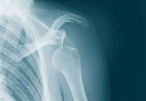 Have You Had Problems With Your Shoulder If You Feel The Joint Has