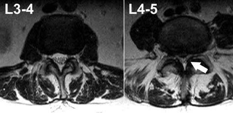 Making Sense Of MRI Of The Lumbar Spine NUTRITION LINE