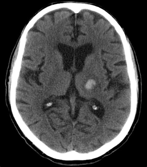 Basal Ganglia Hemorrhage Pacs