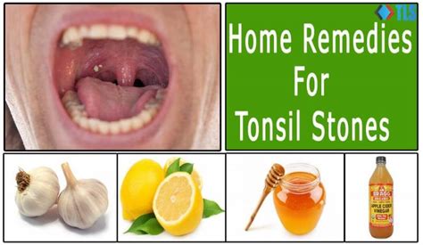 Tonsil Stones Remedy Forever Review Must Knowing Before You Buy