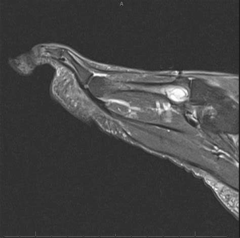 Subchondral Cyst The Foot And Ankle Online Journal