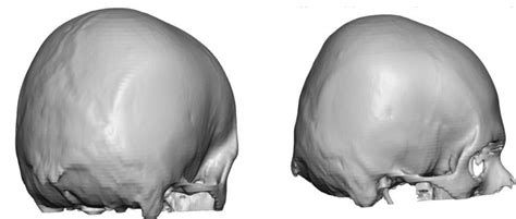 Plastic Surgery Case Study Male Custom Skull Implant For Flat Back Of