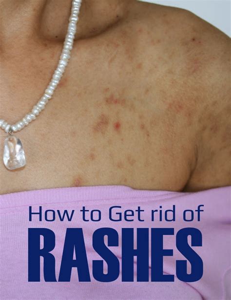 How To Get Rid Of Rashes Tips Park