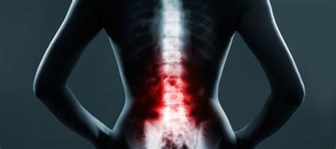 5 Treatment Options For Spinal Arthritis Minneapolis Spine Surgery