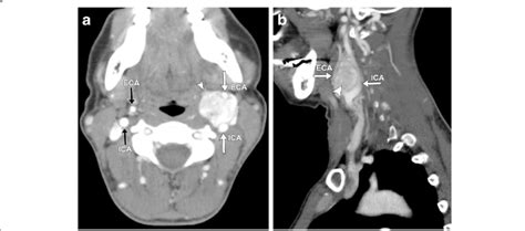 Axial A And Sagittal B Contrast Enhanced Ct Of The Neck
