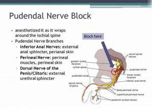 Pudendal Nerve Block Amara Pain Spine Management
