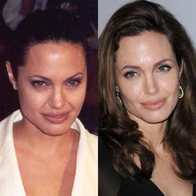 Trendystyle Angelina Jolie Plastic Surgery Before And After