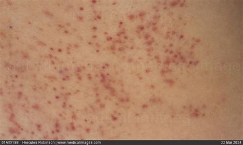 Stock Image Dermatology Petechia From Vomiting A Fine Red Vesicular