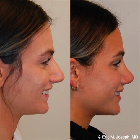Eric M Joseph Md Rhinoplasty Before And After Results With