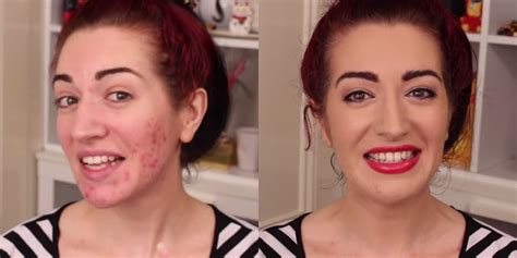 Ways To Hide Acne Without Makeup Saubhaya Makeup