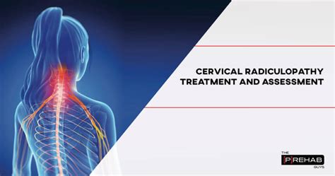 Cervical Radiculopathy Treatment And Assessment 𝙏𝙝𝙚 𝙋𝙧𝙚𝙝𝙖𝙗 𝙂𝙪𝙮𝙨
