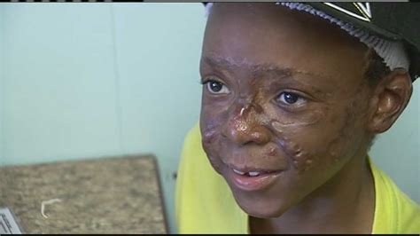 Badly Burned Boys Next Operation Could Cost 30000