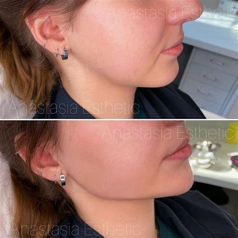 Jawline Enhancement Anastasia Esthetic Dermal Fillers And Skincare