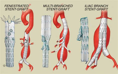 Endovascular Repair Of Complex Aortic Aneurysms Mayo Clinic