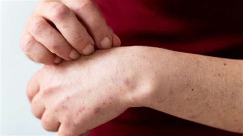 Skin Rashes Here Are Some Effective Home Remedies Lifestyle News India Tv