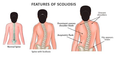 Signs And Symptoms Of Scoliosis Scoli Fit Non Surgical Scoliosis