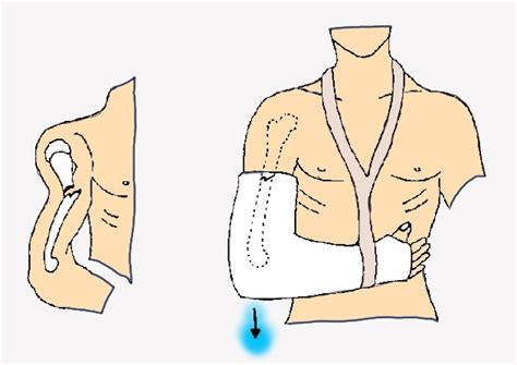 Hanging Cast For Humerus Fracture Therapy Fracture