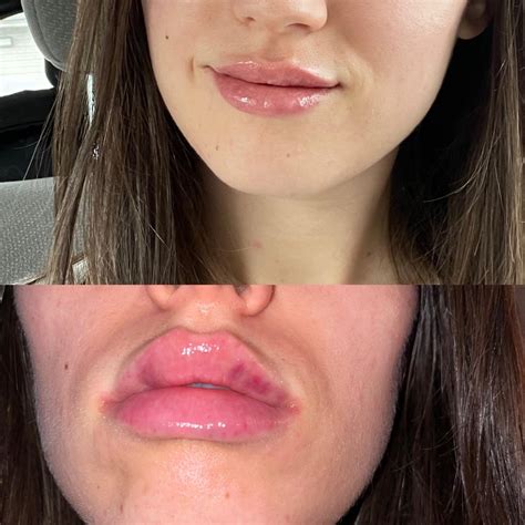 Anyone Have Swelling Problems After Lip Fillers The Top Picture Is 30 Minutes After The