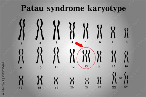Patau Syndrome Karyotype Is The One Of Chromosomal Disorders That Have