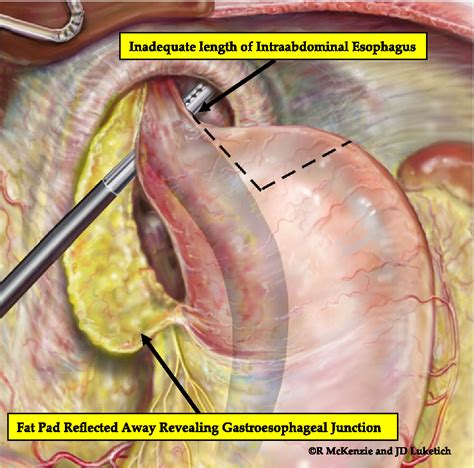 Laparoscopic Treatment Of Large Paraesophageal Hiatal Hernia With An