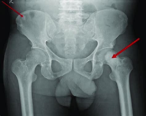 X Ray Of The Pelvis Showing Multiple Sclerotic Lesions Over Right Iliac