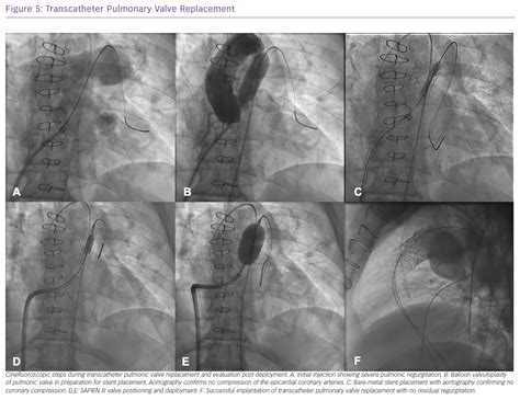 Transcatheter Pulmonary Valve Replacement Radcliffe Cardiology