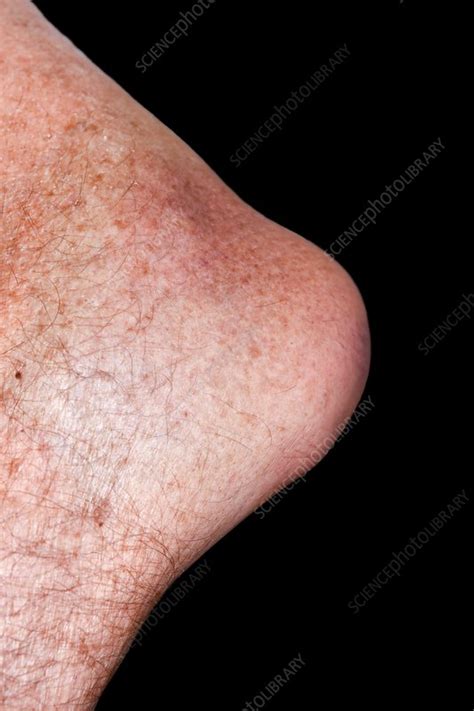 Bursitis Of The Elbow Stock Image C0345434 Science Photo Library